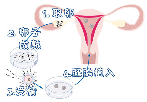 卵巢评估